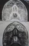 Расшифровка Рентгена носовых пазух фото 1