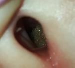 Гнойный синусит у ребенка, лечение не помогает фото 2