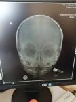 Перелом черепа фото 2