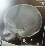 Двойной перелом черепа фото 1