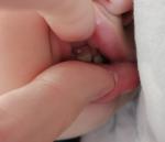 Налет зуб у ребенка 8 фото 1