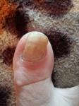 Как и сколько нужно принимать Флуконазол при грибке ногтя? фото 1