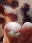 Как и сколько нужно принимать Флуконазол при грибке ногтя? фото 2