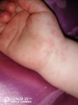 Красная сыпь по всему телу у ребенка фото 3