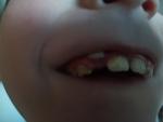 Зуб вне десны фото 1