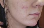 Проблемы с кожей лица, белые точки фото 3