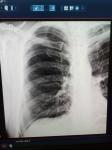 Плеврит и туберкулез фото 2