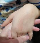 Сыпь и зуд на кистях рук у ребенка фото 3
