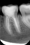 Трещина зуба фото 1