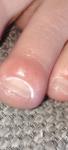Воспаление на пальце ноги фото 4
