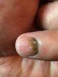 Заболевание ногтя фото 1