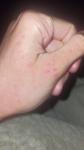 Трещины на сгибах рук, внешняя часть ладони фото 1
