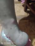 Красные болезненные шишки на руках и ногах фото 2