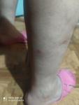 Красные болезненные шишки на руках и ногах фото 3