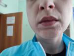 Сыпь на лице в зоне носогубного треугольника фото 1