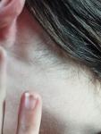 Уплотнение за ухом как избавиться и что делать? фото 1