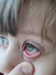 Красные глаза с гноем у ребенка фото 1