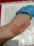 Аллергия на руках, зуд, пятна фото 1