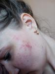 Дерматит или аллергия, усапанны щеки на лице фото 3