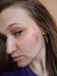 Дерматит или аллергия, усапанны щеки на лице фото 4