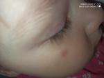 Красное пятно на щеке у ребёнка фото 2