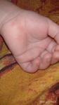 Красная сыпь у ребенка на стопах и ладони фото 1