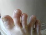 Кривой указательный палец на ноге фото 2
