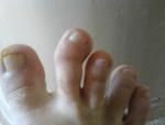 Кривой указательный палец на ноге фото 3