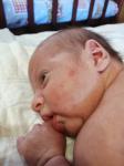 Потница или акне новорожденного фото 1