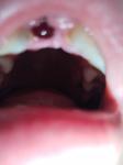 Кровяной пузырь после удаления зуба фото 2