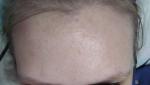 Мелкая подкожная сыпь на лице с черными точками фото 2