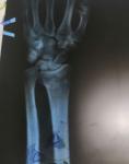 Перелом правой лучевой кости фото 3