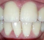 Трещина в зубе фото 1