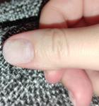Аллергия или грибок ногтей фото 1