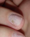 Аллергия или грибок ногтей фото 2