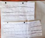 Тема: Отклонение электрической оси сердца влево. Нарушение внутрижелудочковой проводимости фото 1