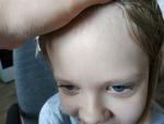 Высыпания на лице у ребенка 10 лет фото 5