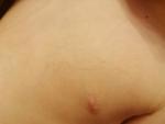 Сыпь полосой у ребёнка на груди фото 1