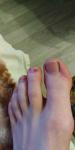 Коричневое пятно на ногте пальца ноги фото 1
