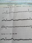 Расшифруйте ЭКГ, пожалуйста. Почему патологическая фото 2