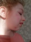 Красные пятна у ребёнка на лице, немного шершавые фото 1