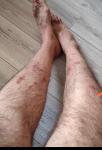 Как лечится от зудящих пятен на ногах? фото 1