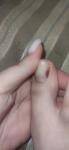 Темное пятно на ногте, меланома фото 4