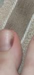 Темное пятно на ногте, меланома фото 3
