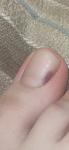 Темное пятно на ногте, меланома фото 2