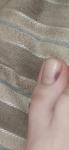 Темное пятно на ногте, меланома фото 1
