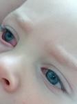 Покраснение глаз у ребенка фото 1