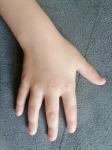 Сыпь на кистях рук у ребенка фото 3