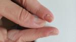 Поражение ногтевых пластин пальцев рук фото 1