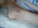 Красно-фиолетовые пятна на ногах ребёнка фото 5